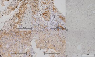 Overexpression of EGFR and TGFα in von Hippel–Lindau-Related Central Nervous System Hemangioblastomas